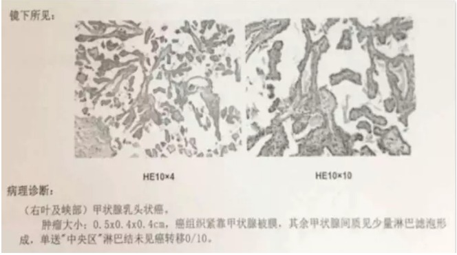 別慌，甲狀腺疾病還可以這樣投保！