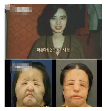 整容發(fā)生意外保險賠嗎？